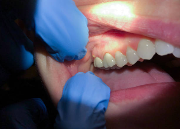 Best Emergency Care for Gum Disease in Terrell Hills, TX