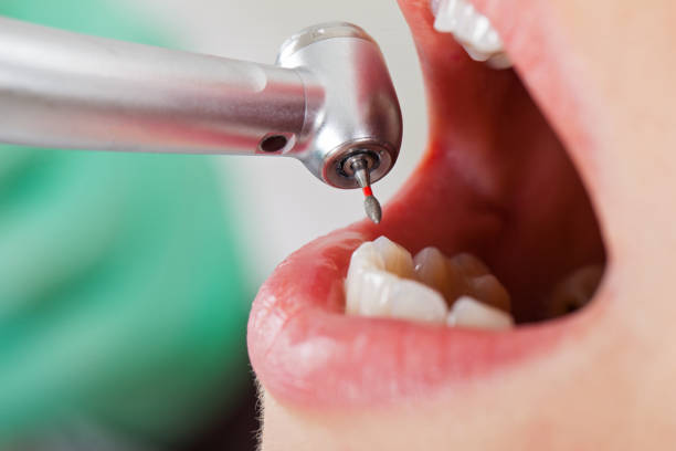 Best Knocked-Out Tooth (Avulsed Tooth) Treatment in Terrell Hills, TX